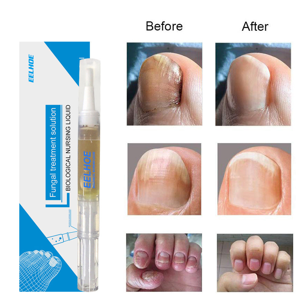 EELHOE Nail Repair Liquid Hand and Foot Onychomycosis Care Repair Onychomycosis Liquid Thickening soft Nails 