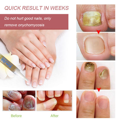 EELHOE Nail Repair Liquid Hand and Foot Onychomycosis Care Repair Onychomycosis Liquid Thickening soft Nails 