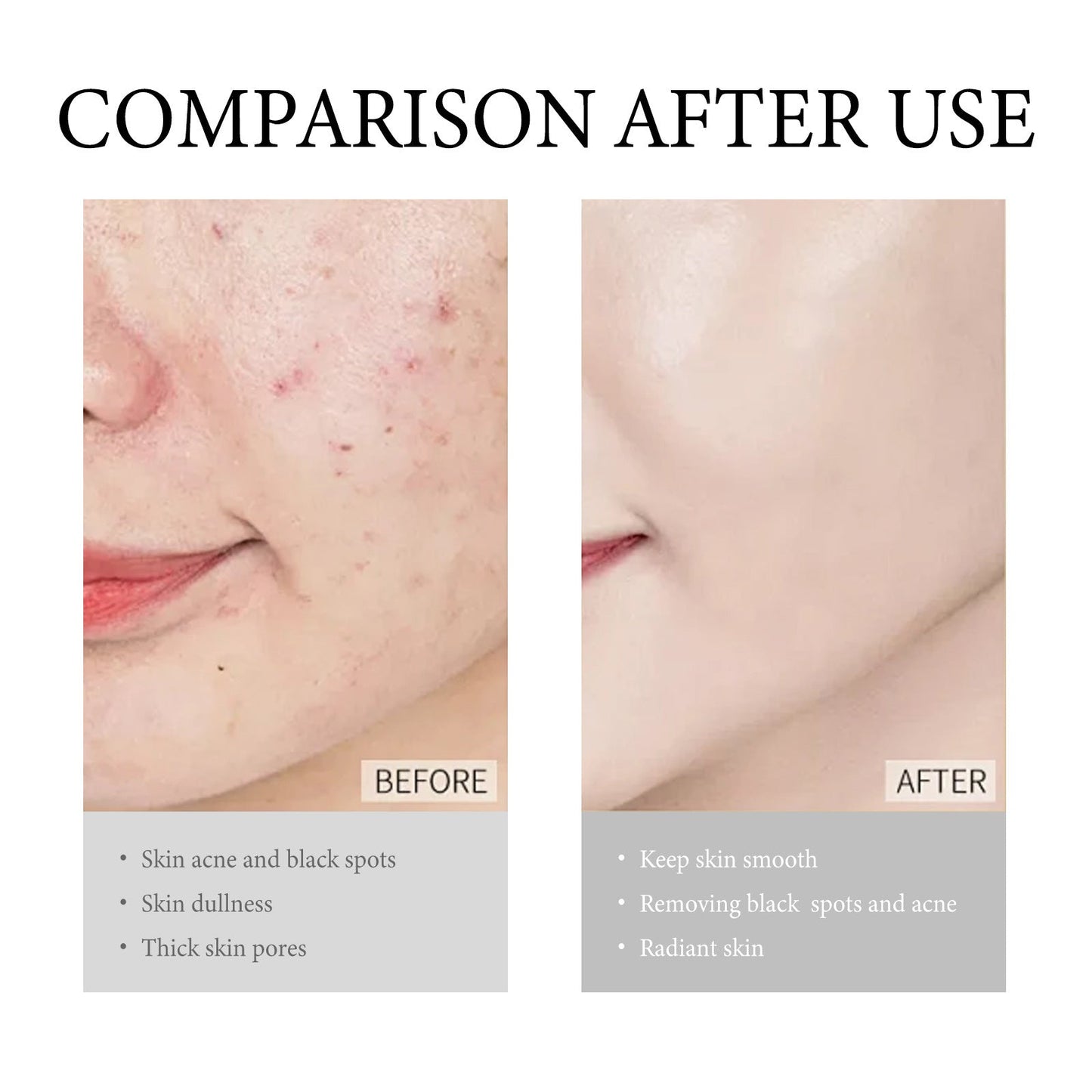 WIYUN Anti-acne Cream Deep Cleansing Moisturizing Facial Skin Lightens Acne Scars Blackhead Repair Cream 