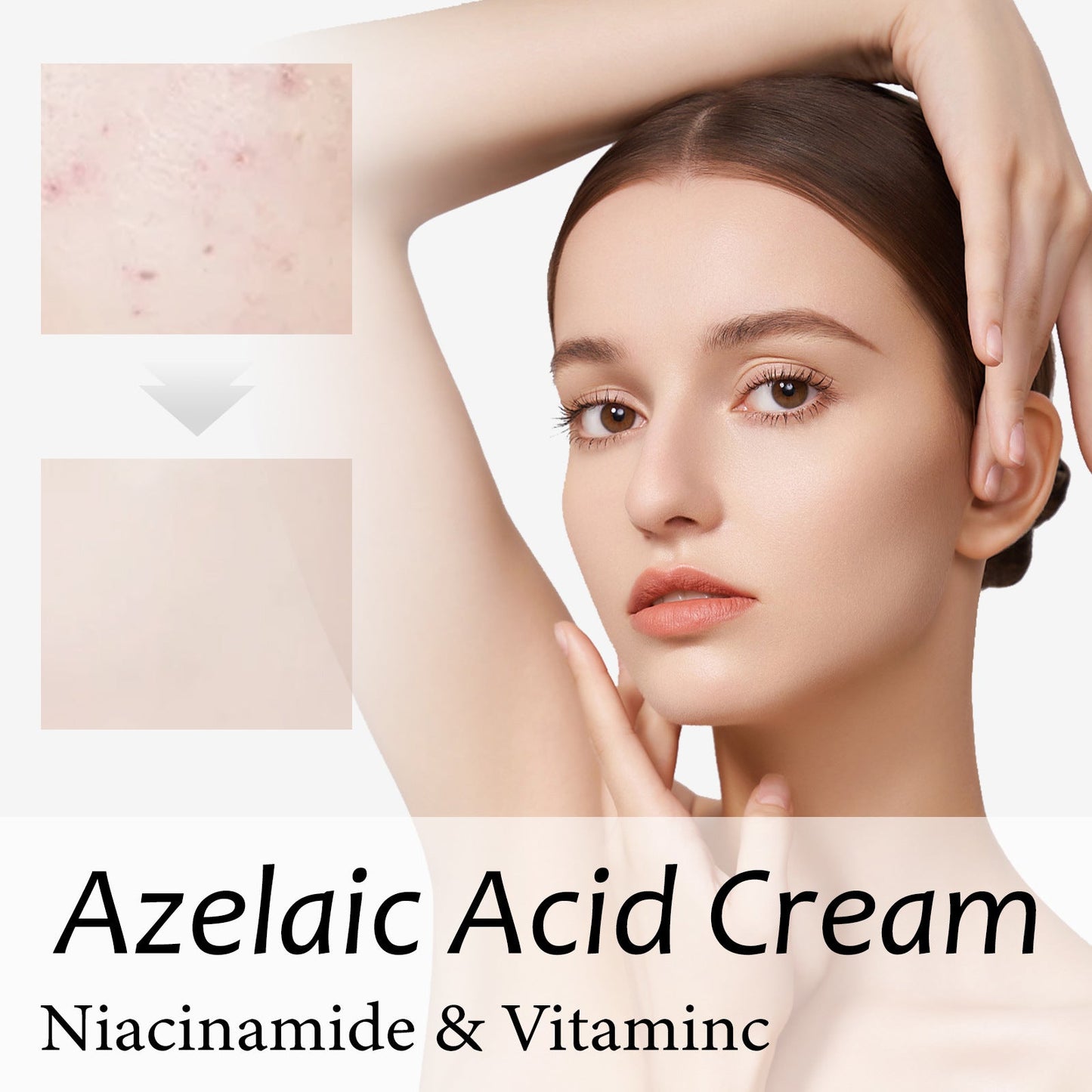 WIYUN Anti-acne Cream Deep Cleansing Moisturizing Facial Skin Lightens Acne Scars Blackhead Repair Cream 