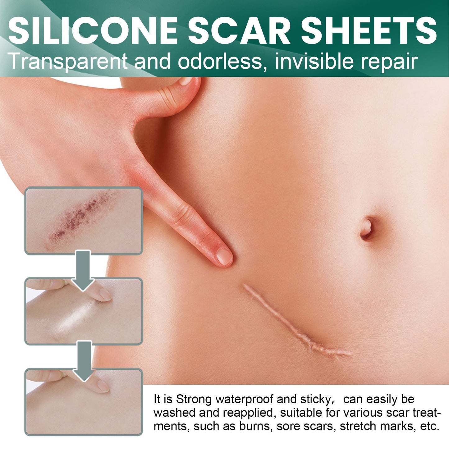 EELHOE Silicone Scar Patch ការ​ពពោះ​ការ​វះកាត់​វះកាត់​រលាក​ស្លាកស្នាម​ពណ៌​ដែល​មើល​មិន​ឃើញ បំណះ​ជួសជុល​ស្លាកស្នាម​ 