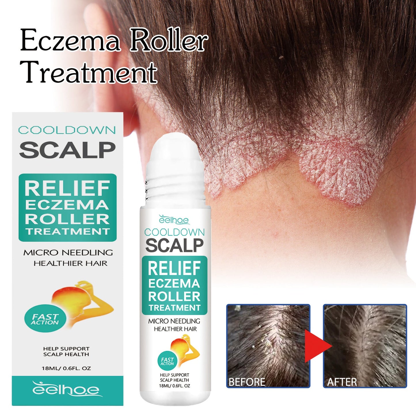 EELHOE Scalp Care Roller Ball ជួសជុលស្បែក Moss និងអង្គែស្បែកក្បាល សម្អាតយ៉ាងជ្រៅ និងផ្តល់សំណើមដល់ស្បែកក្បាល Roller Ball 