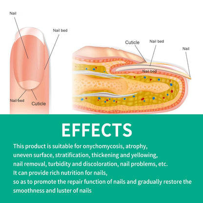 South Moon Onychomycosis Cream Care Hand, Foot, and Toenail Thickening Bright Nail Onychomycosis Repair Soft Nail Cream 