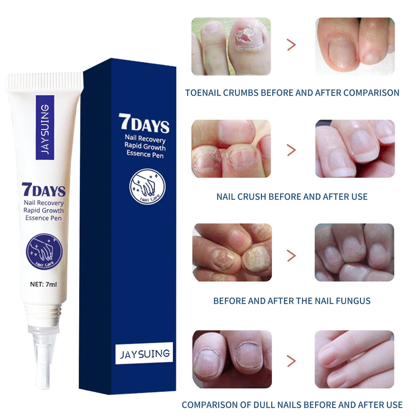 Jaysuing 7-day nail repair essence liquid hand and foot nail care rotten toenails bright nails onychomycosis repair liquid 