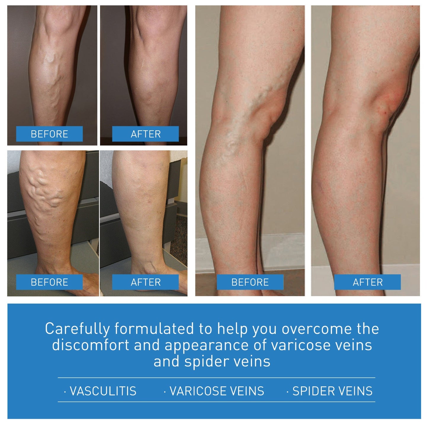 EELHOE vein massage cream relieves varicose veins and relieves pain caused by raised blood vessels in the legs 