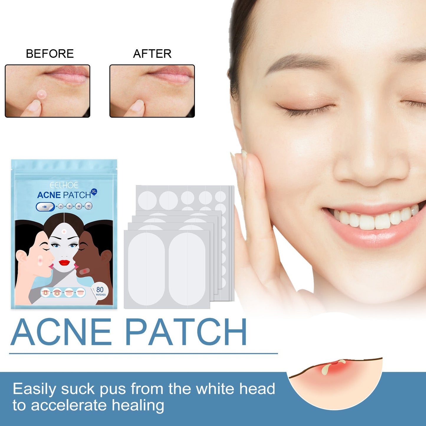 EELHOE acne patch invisible acne patch anti-acne closed comedones waterproof makeup concealer hydrocolloid oil acne patch 