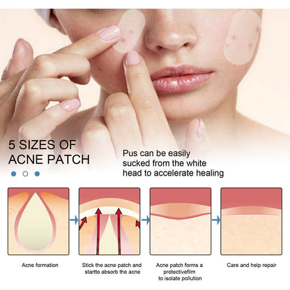 EELHOE Acne Patch Invisible Acne Cleansing Patch Anti-acne Closed Acne Waterproof Makeup Concealer Hydrocolloid Oil Acne Patch 