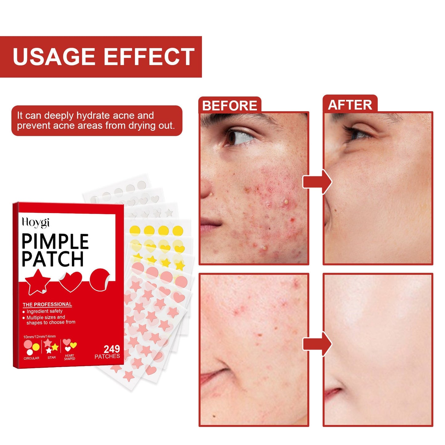 Hoygi facial color acne patch deep moisturizing reduce acne acne repair skin barrier cute pattern 