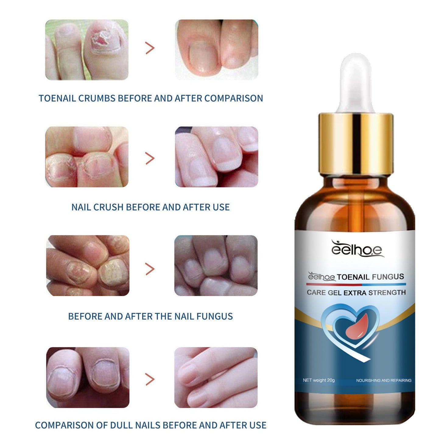 EELHOE nail care gel for hands and feet, yellowing and thickening of nails, onychomycosis, soft nails, bright nail care gel 