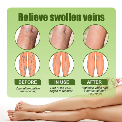 EELHOE slimming vein patch បំបាត់ការហើមនៃសាច់ដុំជើង vein, earthworm leg body discomfort body patch 