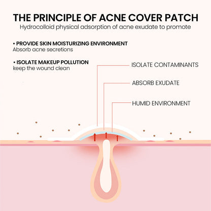 Jaysuing Acne Patch បំបាត់ស្នាមអុចខ្មៅ ជួសជុលស្នាមមុន និងស្នាមជាំ បិទបាំងស្នាមមុន 