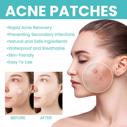 West&amp;Month acne patch repairs acne and blackheads, cleans pores, invisible, breathable, concealer, waterproof, acne-clearing patch 