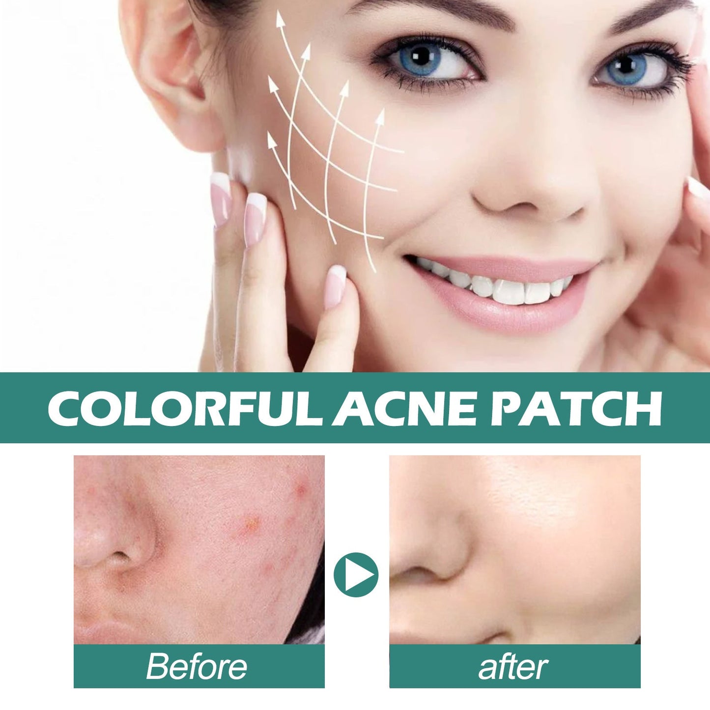 EELHOE Colored Acne Patch សម្អាតផ្ទៃមុខមិនស្អាត បំបាត់មុន រន្ធញើស តុល្យភាពស្បែក 