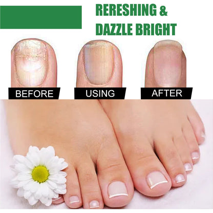 EELHOE Onychomycosis Repair Solution Toenail Tea Tree Oil Finger Thick Soft Nail Nutrition Hand and Foot Nail Care Solution 