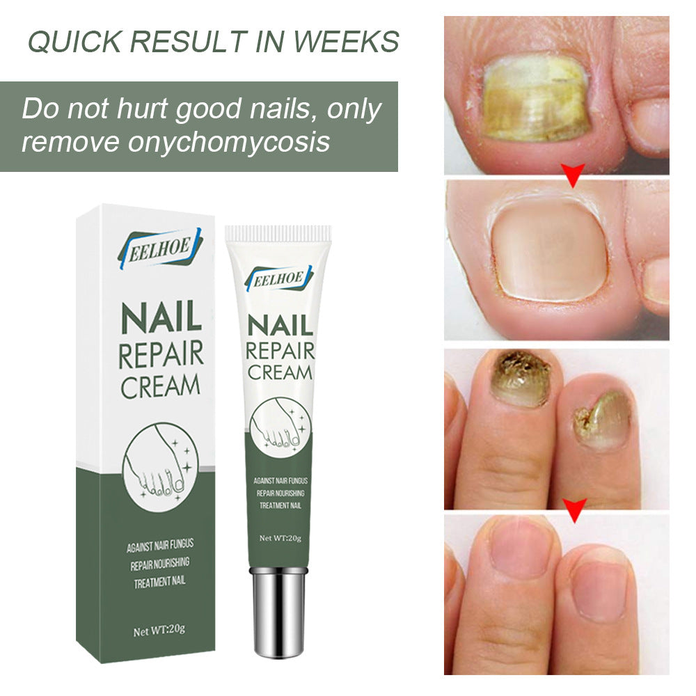 EELHOE nail care cream onychomycosis hand and foot care thickening onychomycosis clean soft nail cream 