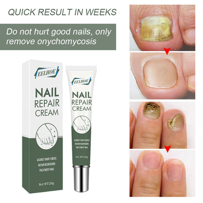 EELHOE Nail Care Cream Onychomycosis Hand and Foot Care Thickening Onychomycosis Soft Nail Cream 