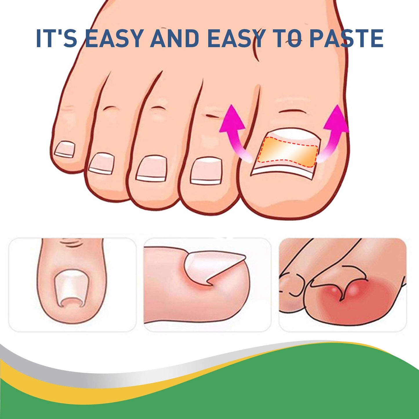 Jaysuing Toenail Groove Correction Stickers Toe Ingrown Nails Correction Pull-Up Stickers Nail Repair Stickers Nail Art 