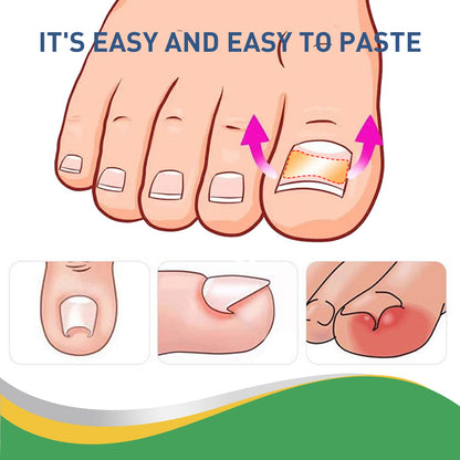 Jaysuing Toenail Groove Correction Stickers Toe Ingrown Nails Correction Pull-Up Stickers Nail Repair Stickers Nail Art 