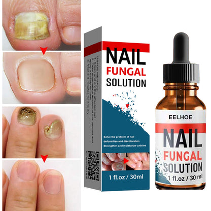 EELHOE Nail Repair Liquid Hand and Foot Onychomycosis Care Repair Onychomycosis Liquid Thickening soft Nails 