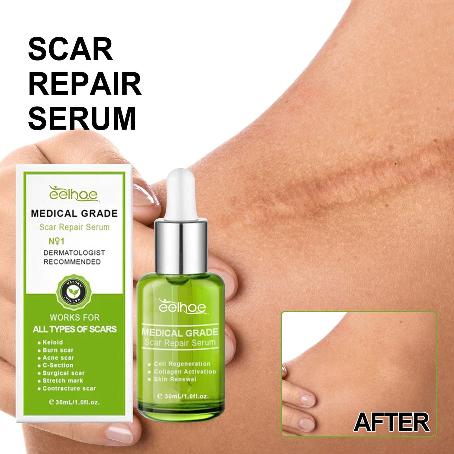 EELHOE Scar Repair Essence បំបាត់ស្លាកស្នាម ស្នាមមុន ស្នាមសង្វារពេលមានផ្ទៃពោះ ធ្វើអោយស្បែកទន់រលោង 