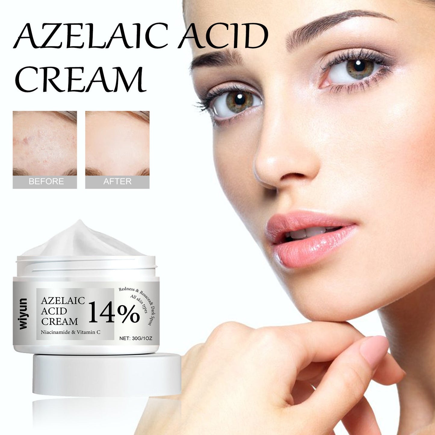 WIYUN Anti-acne Cream Deep Cleansing Moisturizing Facial Skin Lightens Acne Scars Blackhead Repair Cream 