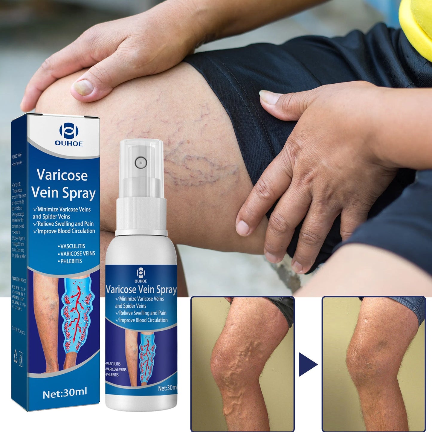 OUHOE vein spray relieves vein care varicose vein bulge pain vein massage care spray 