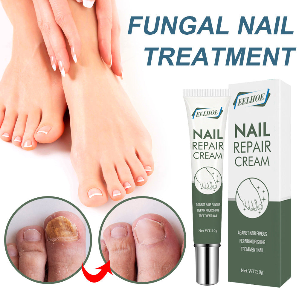 EELHOE nail care cream onychomycosis hand and foot care thickening onychomycosis clean soft nail cream 