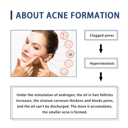 Hoygi Acne Cream Facial Cleansing Repair Lightens Acne Scars Acne Holes Closed Gentle Skin Care Cream 