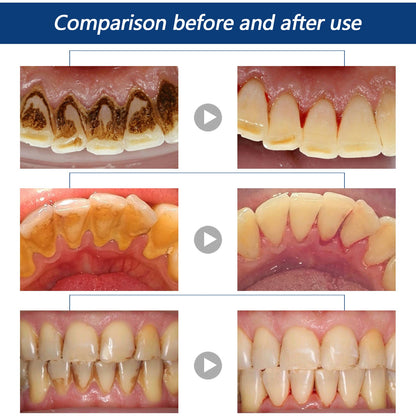 Jaysuing tartar dissolving oral spray ដែលមានក្លិនក្រអូបជាប់បានយូរ ជួយរំលាយ tartar ក្លិនមាត់ និង tartar 
