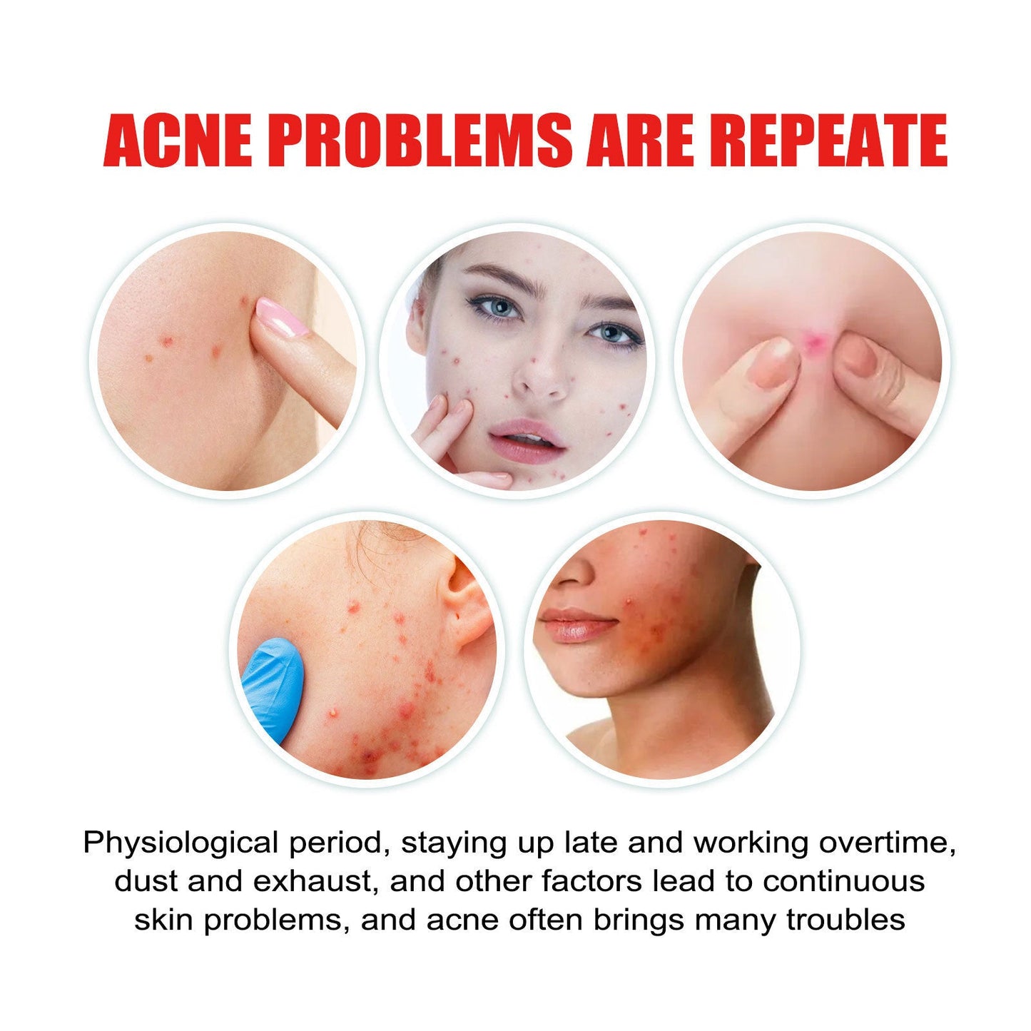 Jaysuing Acne Patch Series Repair, Cleaning, Close, Gentle and Fading Acne Balancing Skin Acne Patch 