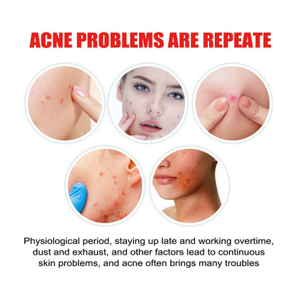 Jaysuing acne patch series repairs and cleanses closed comedones, gently reduces acne and balances the skin 