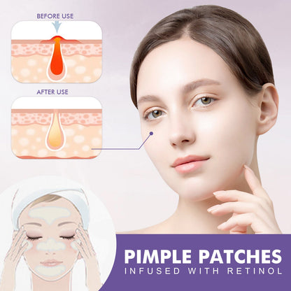 EELHOE Cheek acne patch salicylic acid anti-acne fade acne marks acne closed mild cleansing acne patch 