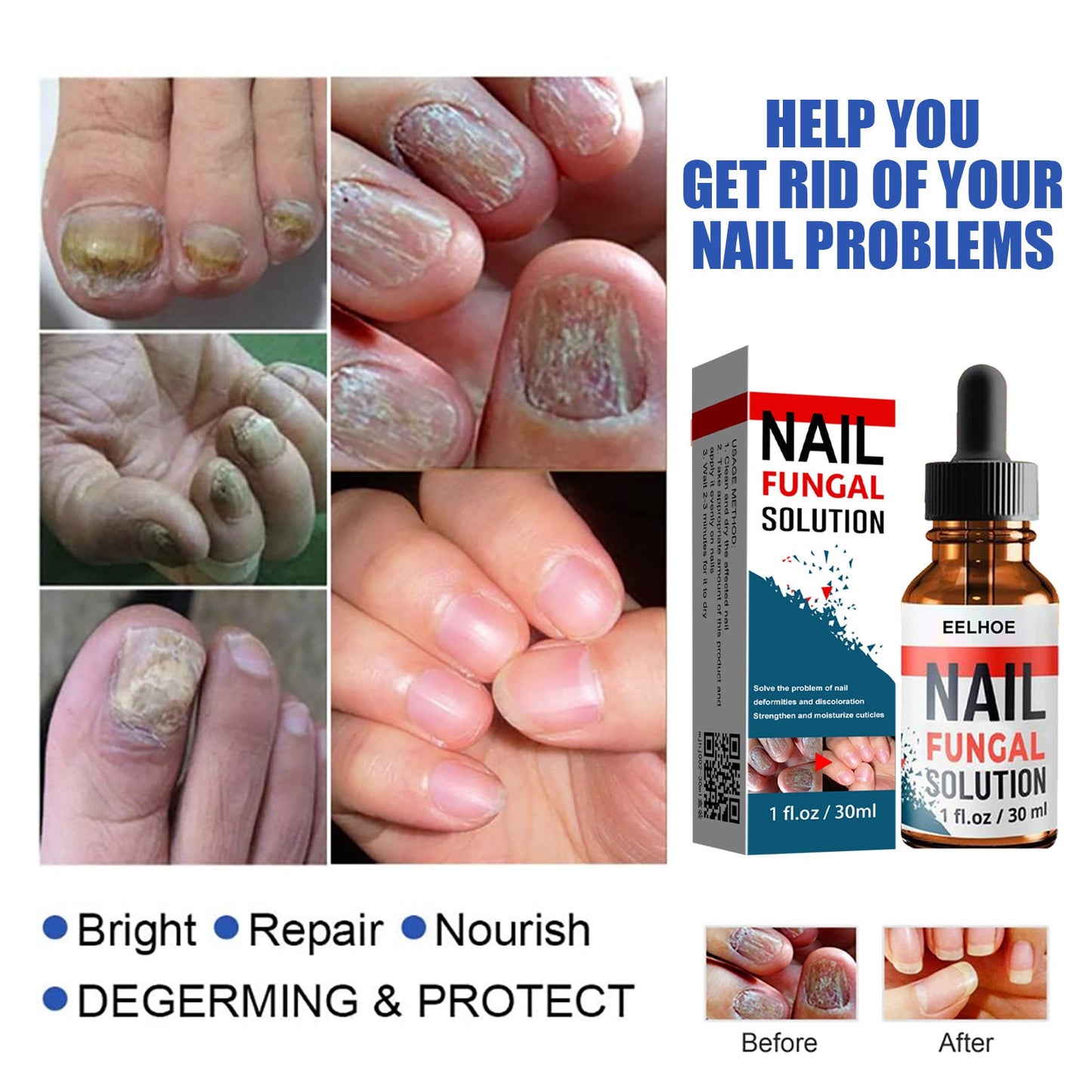 EELHOE Nail Repair Liquid Hand and Foot Onychomycosis Care Repair Onychomycosis Liquid Thickening soft Nails 