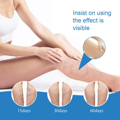 EELHOE vein massage cream relieves varicose veins and relieves pain caused by raised blood vessels in the legs 