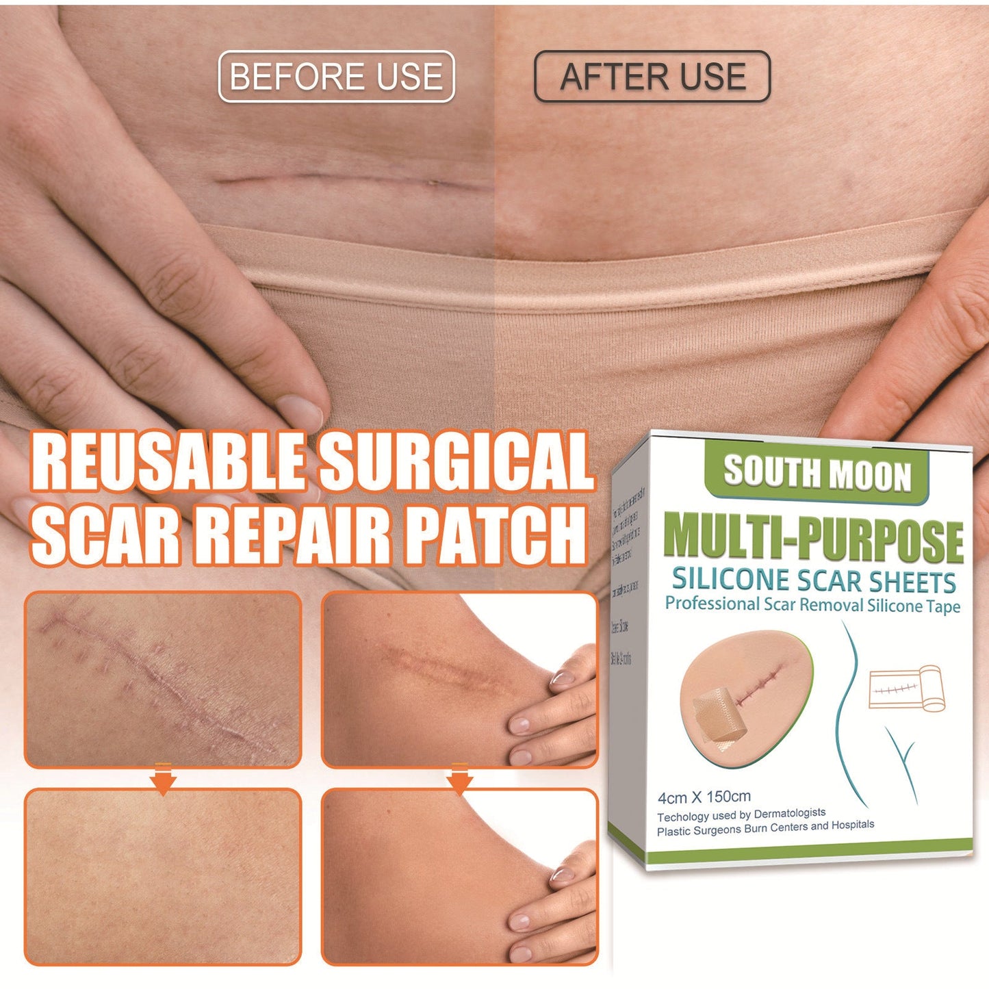 South Moon Silicone Gel Scar Patch Lightens and Repairs Skin Pregnancy Smooths Skin Surgical Scar Patch 