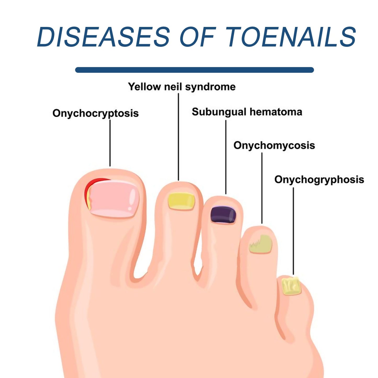 Jaysuing 7-day nail repair essence liquid hand and foot nail care rotten toenails bright nails onychomycosis repair liquid 