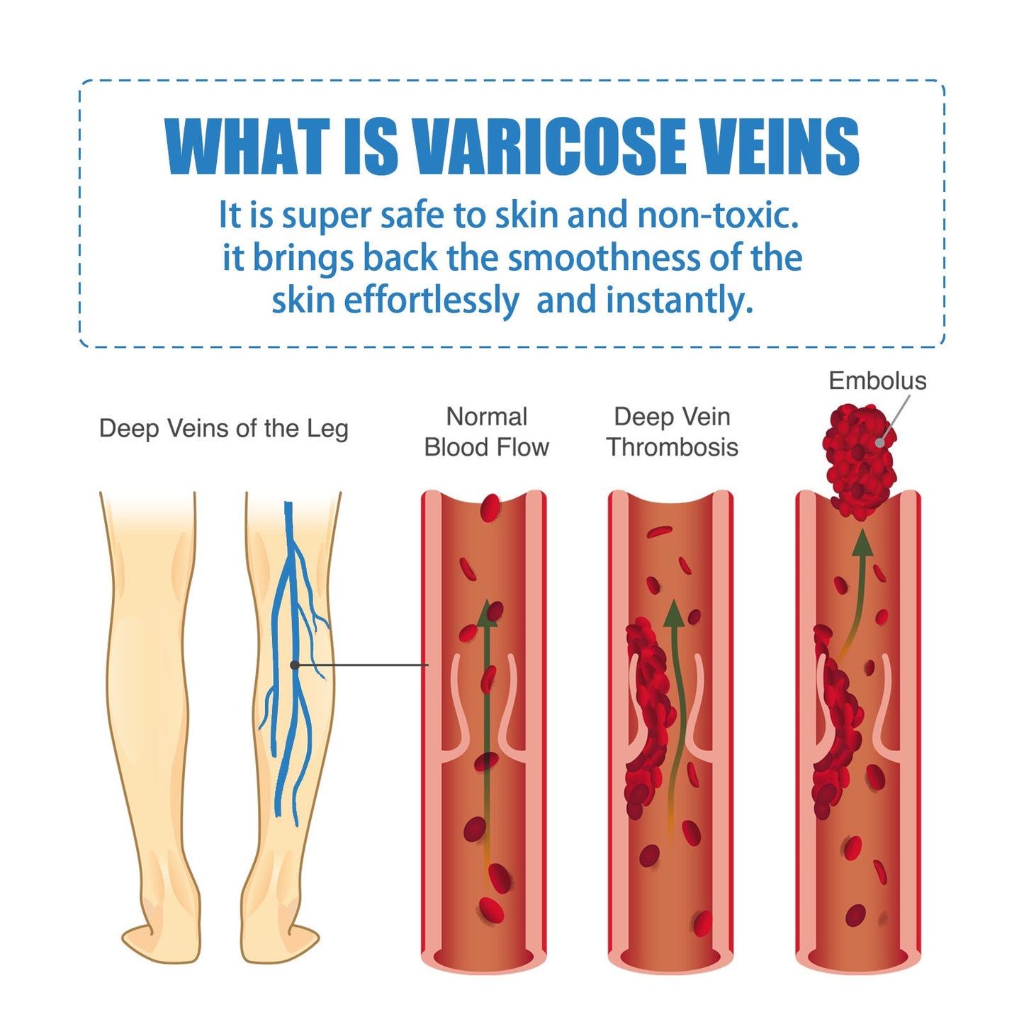 EELHOE vein massage cream relieves varicose veins and relieves pain caused by raised blood vessels in the legs 