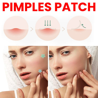 Jaysuing Acne Patch បំបាត់ស្នាមអុចខ្មៅ ជួសជុលស្នាមមុន និងស្នាមជាំ បិទបាំងស្នាមមុន 