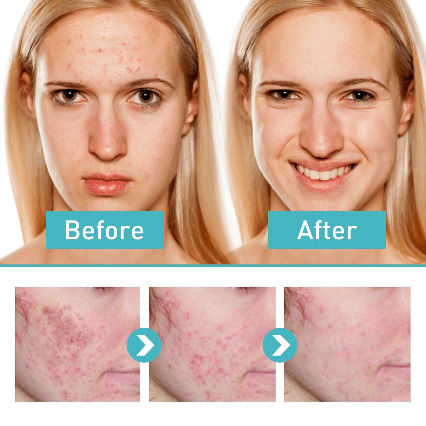 Jayusing Acne Repair Gel បំបាត់ស្នាមមុន ស្នាមមុន ជួសជុល ផ្តល់សំណើម និងធ្វើអោយស្បែកភ្លឺថ្លា។ 