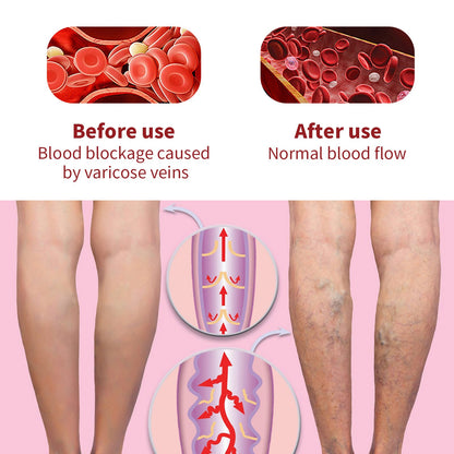 South Moon Leg Vein Repair Cream ម៉ាស្សា Varicose Repair Earthworm Legs ឈាមរត់ និងហើម 