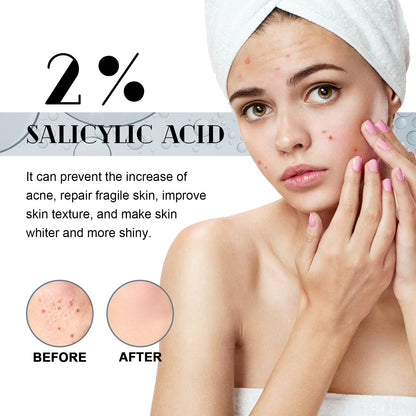 West Month Salicylic Acid Facial Essence, បាត់ស្នាមមុន, ជួសជុល, ផ្តល់សំណើម និងផ្តល់សំណើមដល់ស្បែកមុខ Essence 