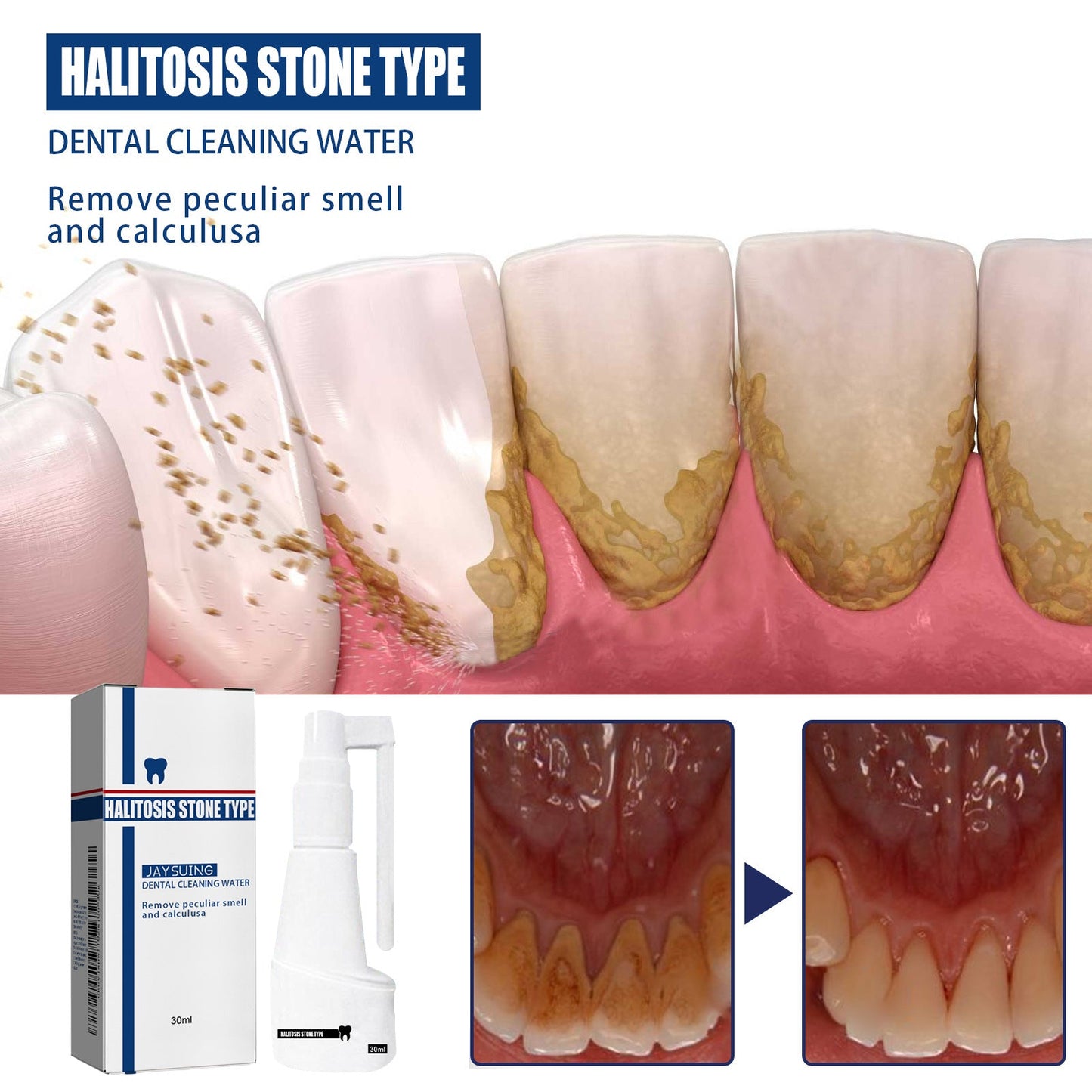Jaysuing牙石溶解口腔喷雾 持久留香味溶解遬牙结石口臭牙垢