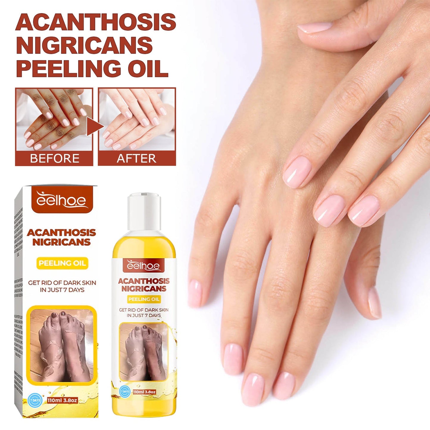 EELHOE Black Acanthus Peeling Oil, Underarm Joint Whitening, ធ្វើអោយស្បែកភ្លឺថ្លា, សម្អាត, ផ្តល់សំណើម និង ប្រេងលាបស្បែក 