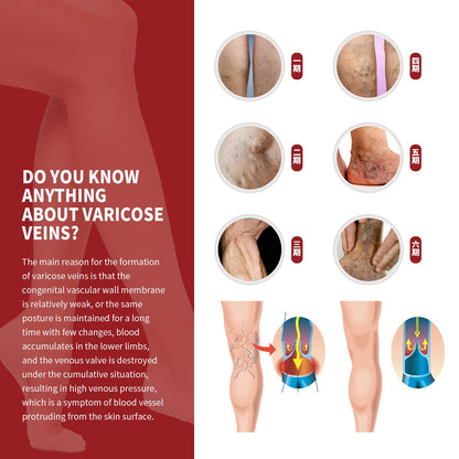 South Moon 腿部静脉修护膏 曲张按摩修护蚯蚓腿血液循环肿胀活络