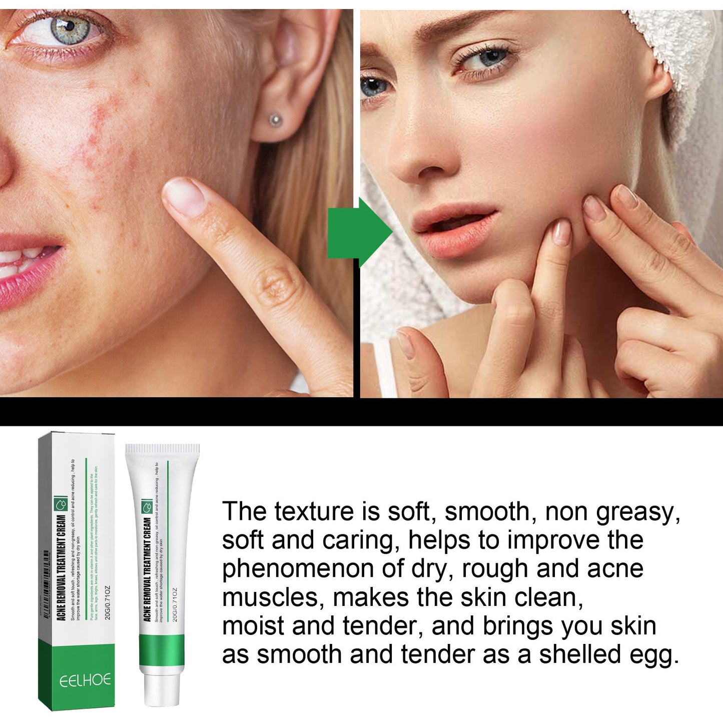 EELHOE Anti-Acne Spot Cream, ស្នាមអុចខ្មៅ, ស្បែកភ្លឺ, ផ្តល់សំណើមដល់ស្បែក, Acne Spots Skin Care Repair Cream 