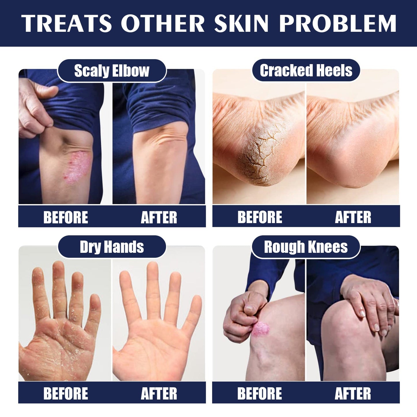 Jaysuing Anti-crack Repair Hand Cream Exfoliates to Improve Cracked and Rough Skin Moisturizing Hand and Foot Cream 