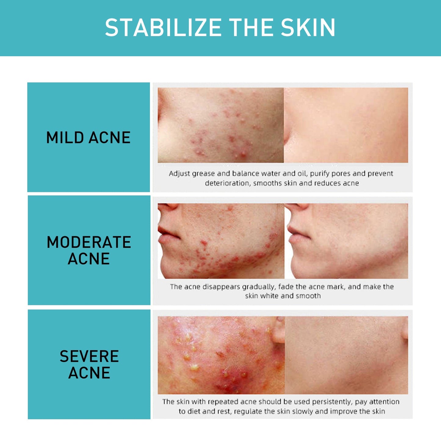 Jayusing Acne Repair Gel បំបាត់ស្នាមមុន ស្នាមមុន ជួសជុល ផ្តល់សំណើម និងធ្វើអោយស្បែកភ្លឺថ្លា។ 