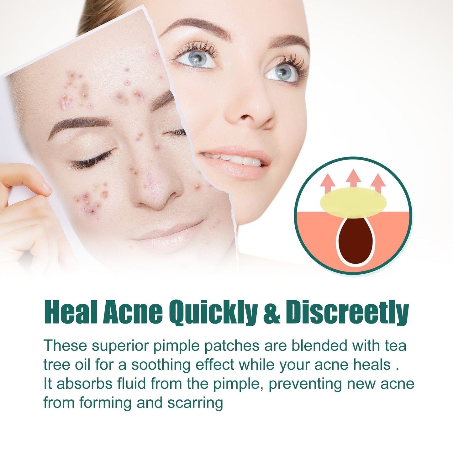 EELHOE Colored Acne Patch សម្អាតផ្ទៃមុខមិនស្អាត បំបាត់មុន រន្ធញើស តុល្យភាពស្បែក 