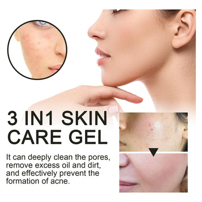 Ouhoe Facial Acne Removal Gel សម្អាតយ៉ាងជ្រៅ និងកាត់បន្ថយស្នាមអុចខ្មៅ និងស្លាកស្នាម ជែលជួសជុលស្បែកដែលមានសំណើម 