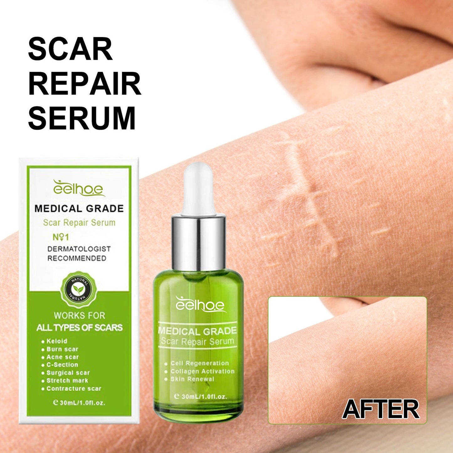 EELHOE Scar Repair Essence បំបាត់ស្លាកស្នាម ស្នាមមុន ស្នាមសង្វារពេលមានផ្ទៃពោះ ធ្វើអោយស្បែកទន់រលោង 